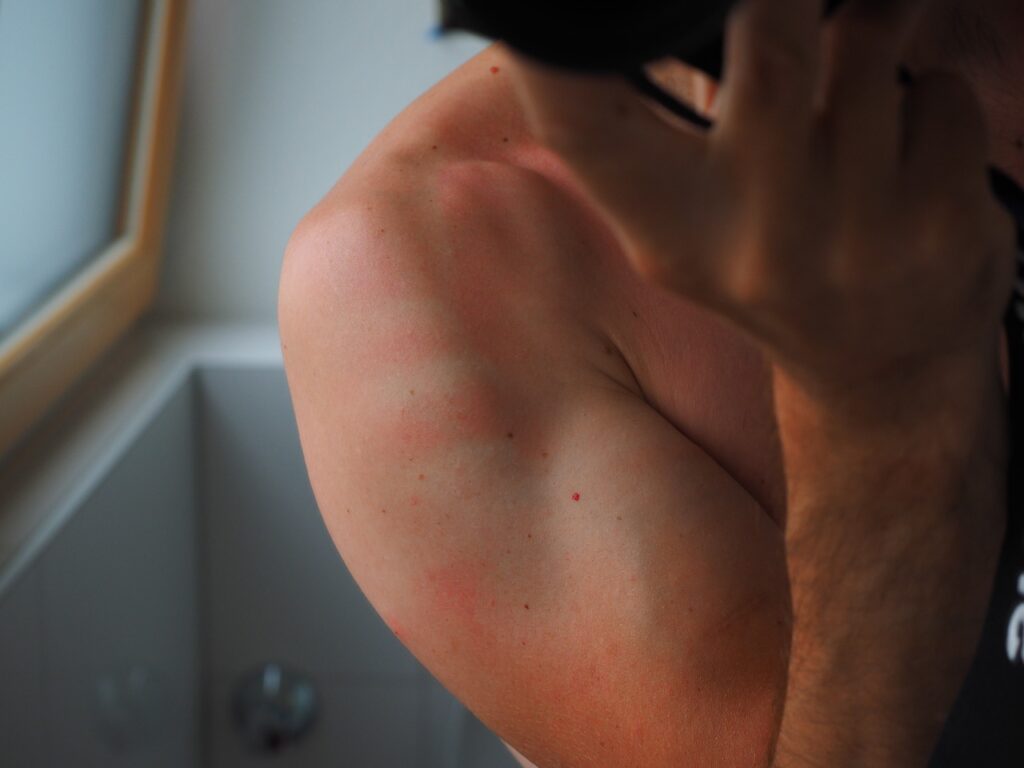 sunburn from cycling